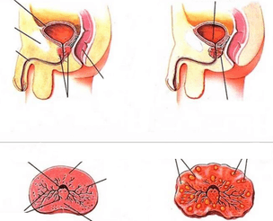 normal nga prostate ug laygay nga prostatitis