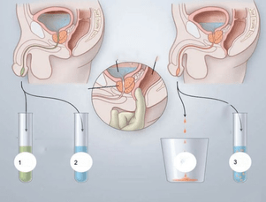 pagmasahe sa prostate