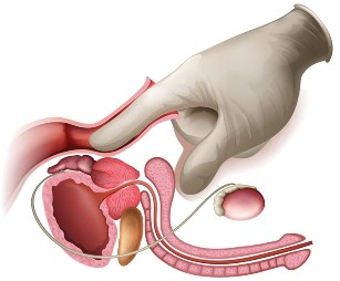 pagmasahe sa prostate