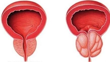 normal ug naghubag nga prostate