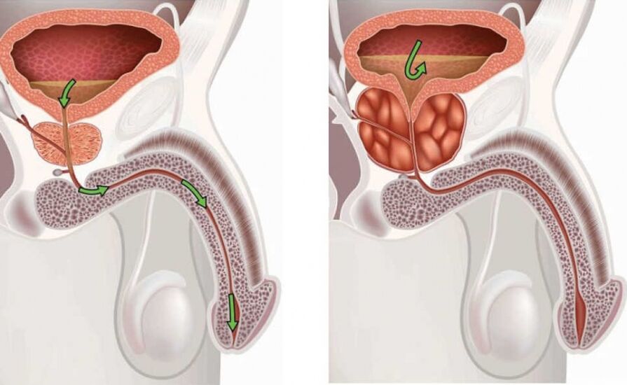 himsog ug masakiton nga prostate sa mga lalaki