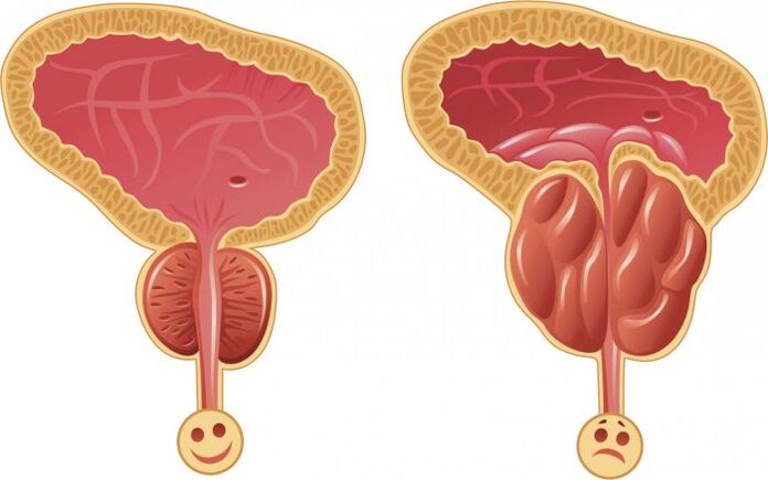himsog ug nahubag nga prostate nga adunay prostatitis