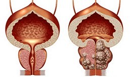 Healthy ug dili maayong prostate