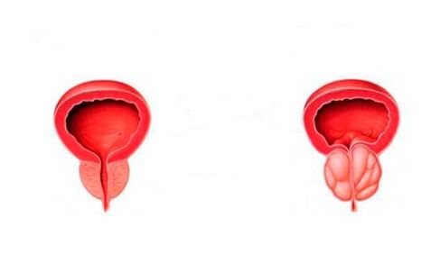 himsog ug nahubag nga prostate nga adunay prostatitis