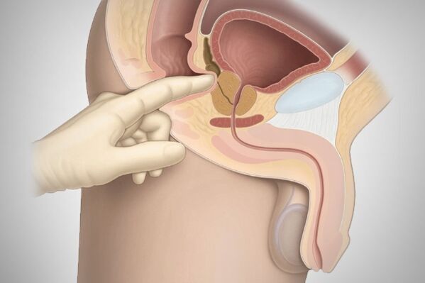 Ang pagmasahe sa prostate alang sa prostatitis sa bakterya