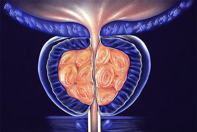 sintomas ug pagtambal sa prostatitis