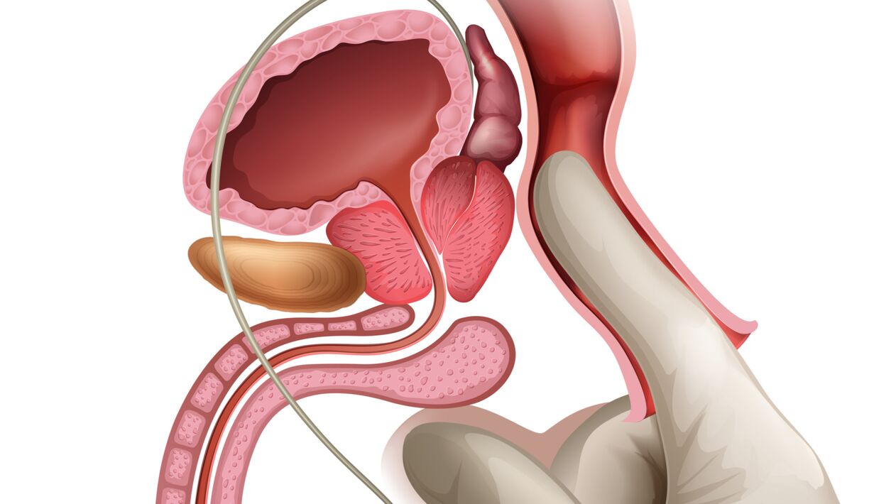 Ang pagmasahe sa prostate usa ka epektibo nga paagi sa pagtambal sa congestive prostatitis