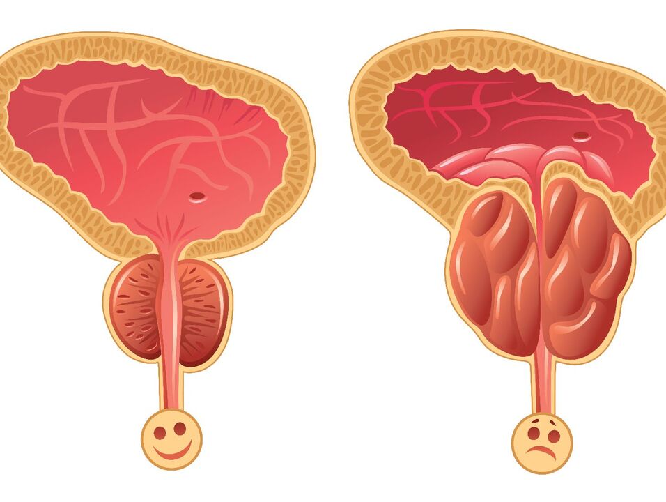 Himsog nga prostate gland ug prostate congestion nga adunay congestive prostatitis