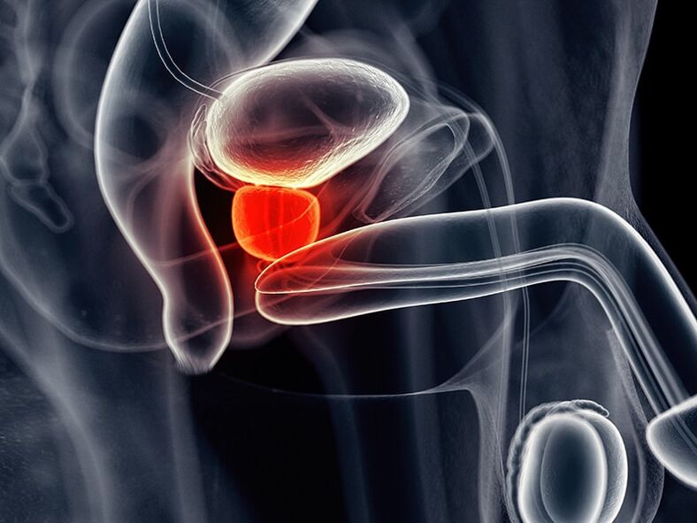 Panghubag sa prostate gland nga nag-uban sa laygay nga prostatitis