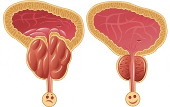 unsa nga paagi nga ang ProstEro prostatitis sa wala pa ug human sa pagtambal